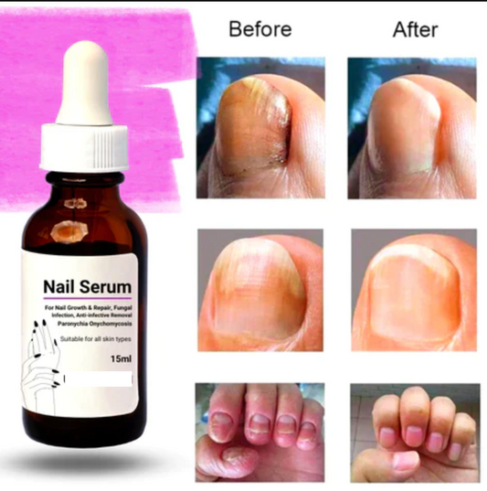 Nail Serum for Nail Growth & Repair, Fungal Infection, Anti-infective Removal Paronychia Onychomycosis